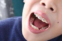 【健康解碼】矯正牙齒真的可以瘦臉嗎？
